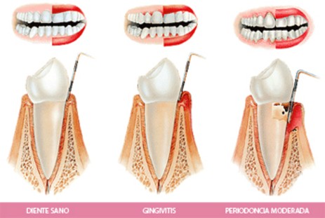 Enfermedades periodontales