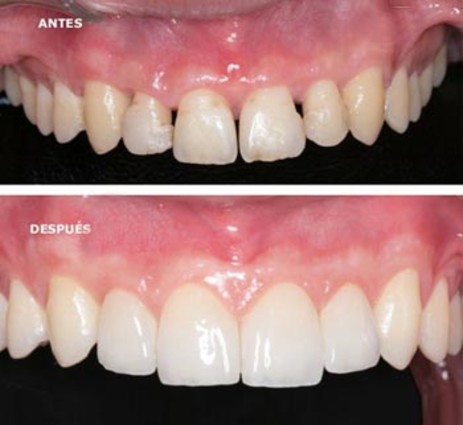 carillas dentales majadahonda