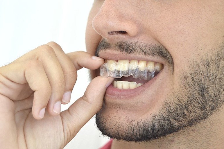 Aparato Invisalign